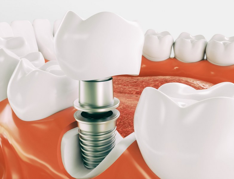 dental implants Liverpool