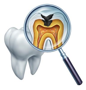 Root Canal Treatment in Maghull, Ormskirk