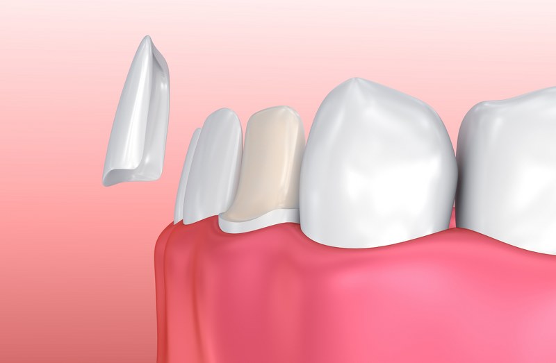 Veneers – Cosmetic Treatment