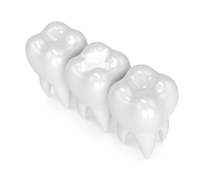 White Fillings – Cosmetic Dental Treatment