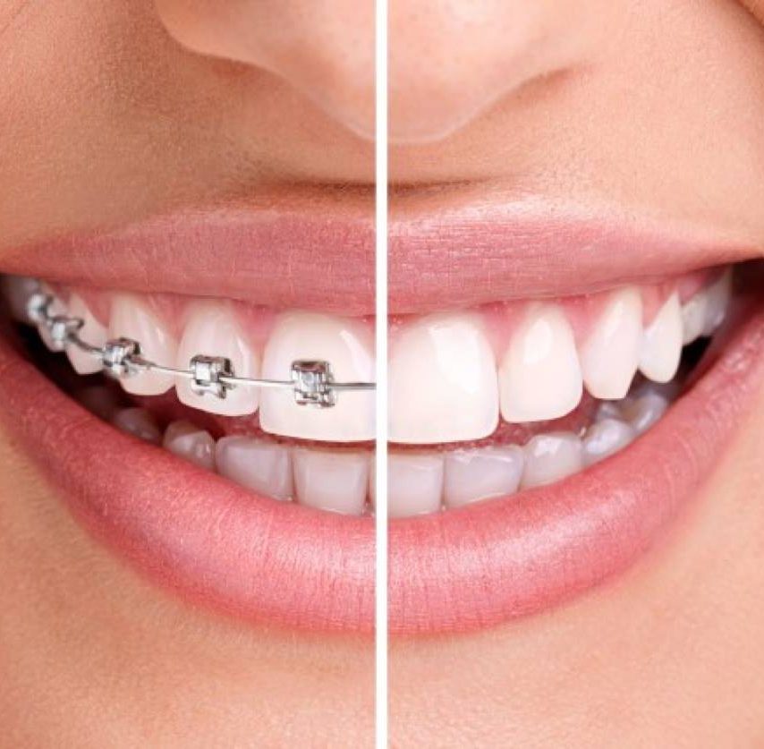 Invisalign vs Fixed Braces Teeth Straightening in Maghull, Liverpool