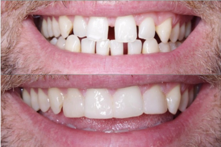 Composite Bonding Cosmetic Dentist Liverpool & Ormskirk