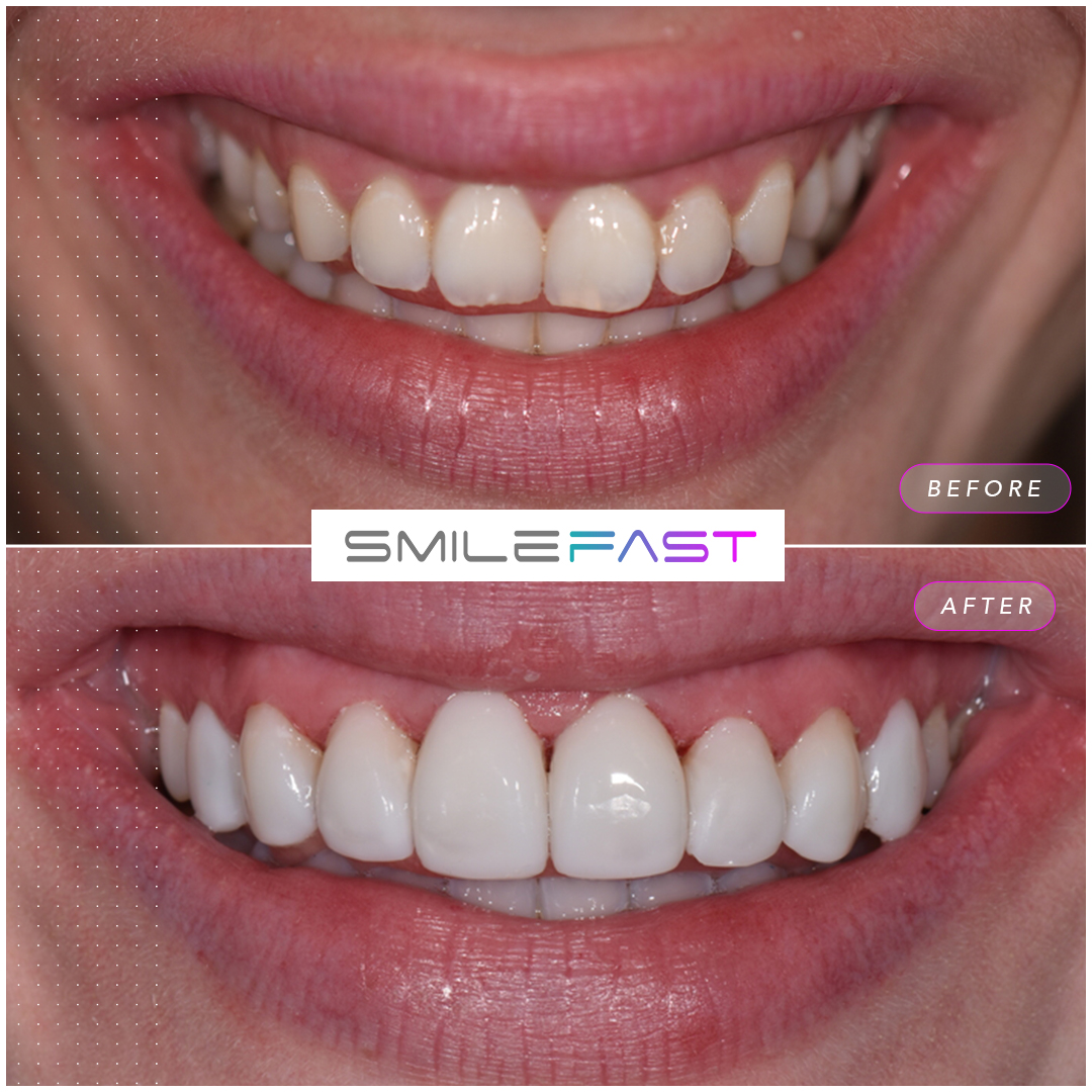 smilefast composite bonding