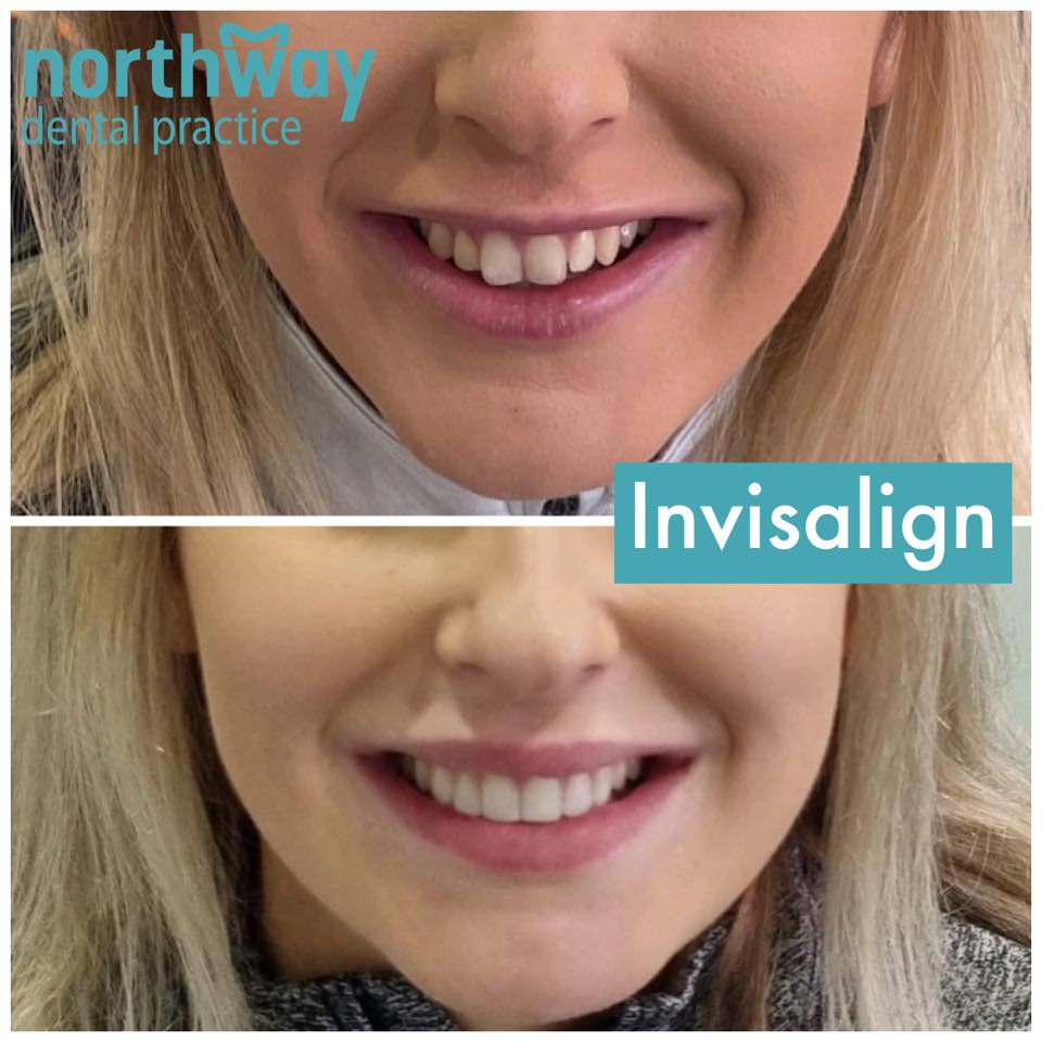 Invisalign Cosmetic Dentist Liverpool & Ormskirk
