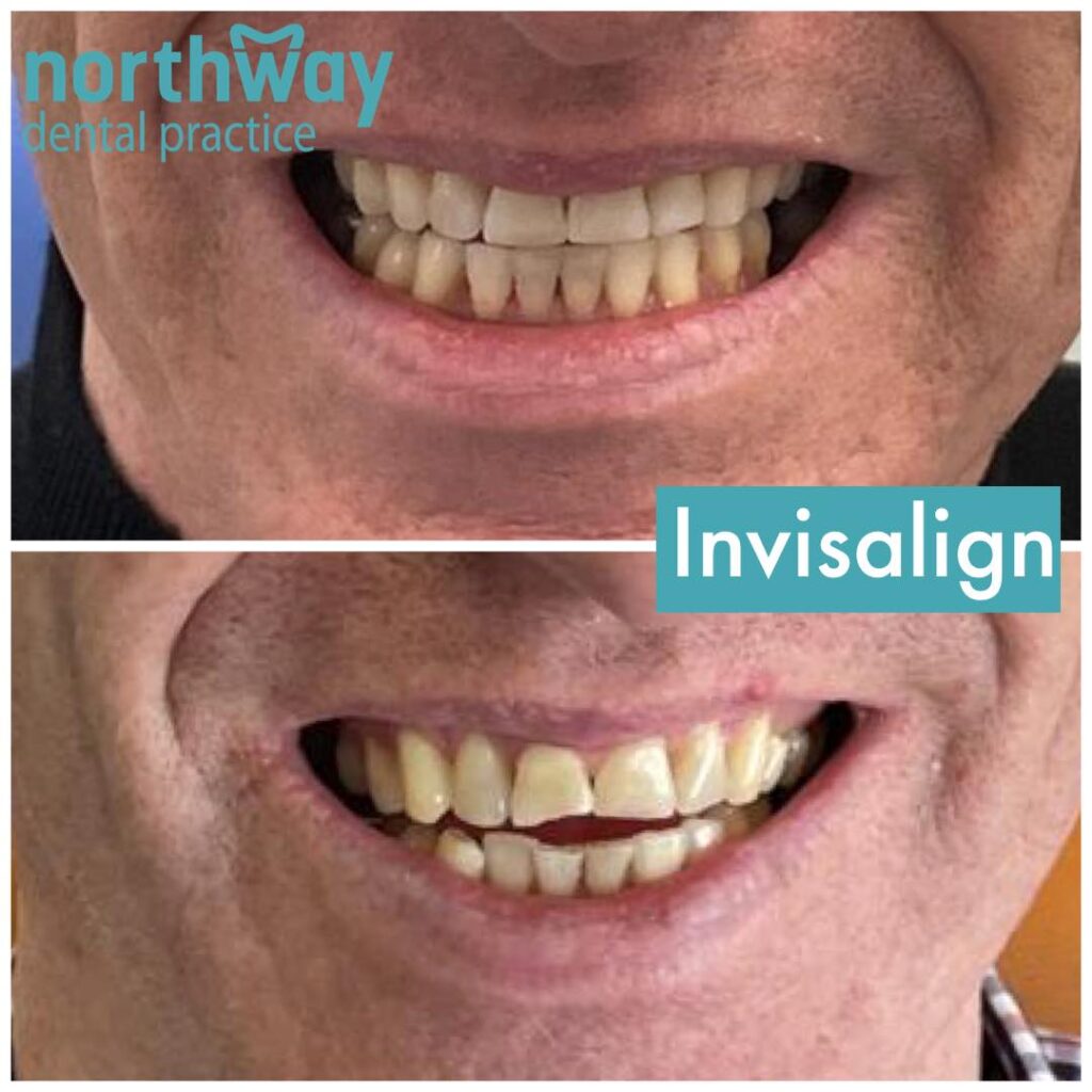 Invisalign Before and after results Liverpool