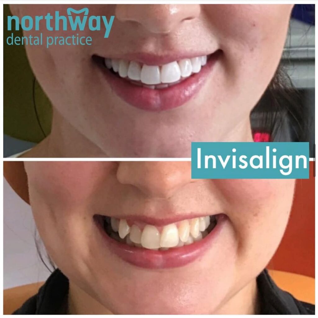 Invisalign Before and After Liverpool