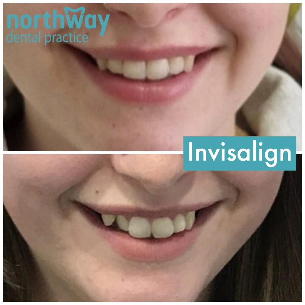 Invisalign Before and After Liverpool