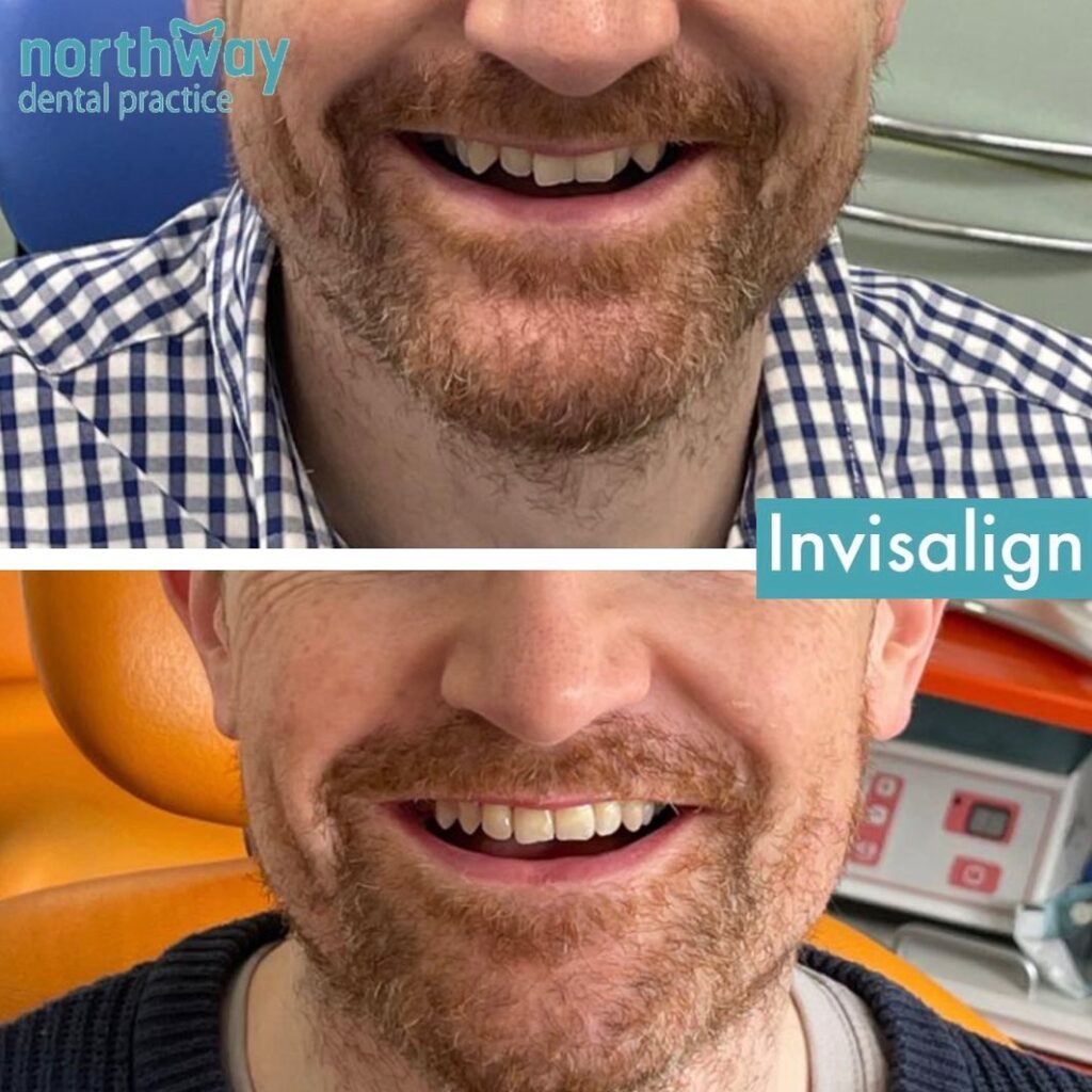 Invisalign Before and after results Liverpool