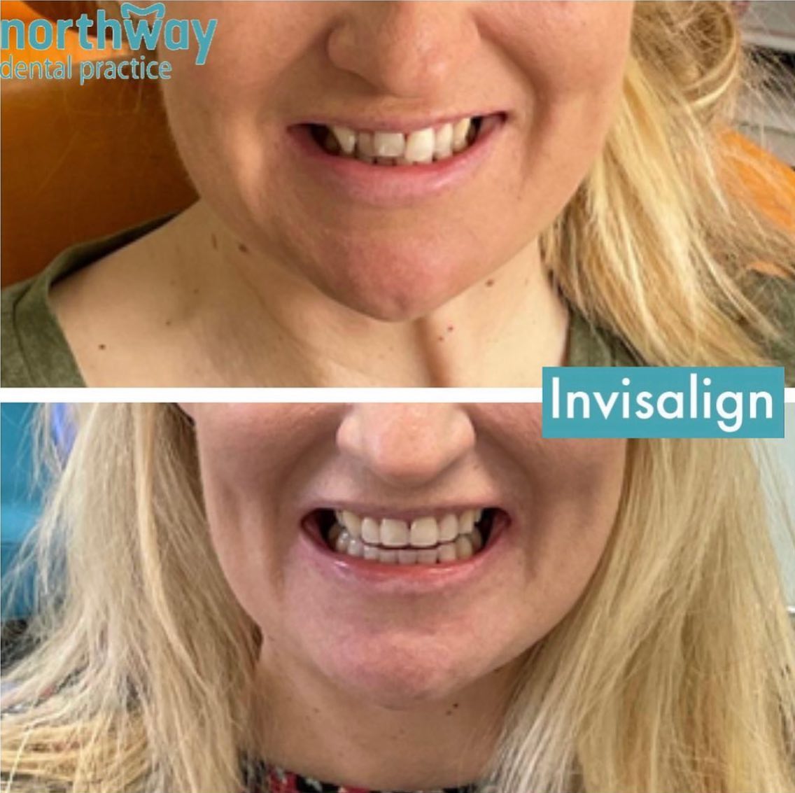 Invisalign Before and after results Liverpool