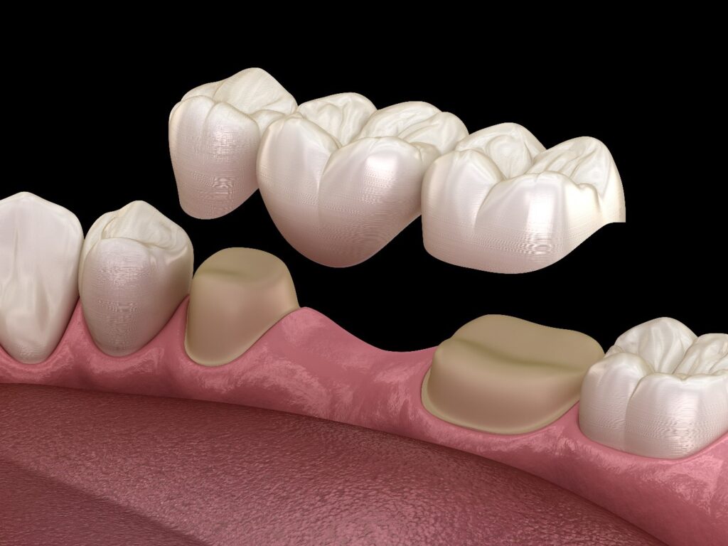 Dental bridges in Liverpool