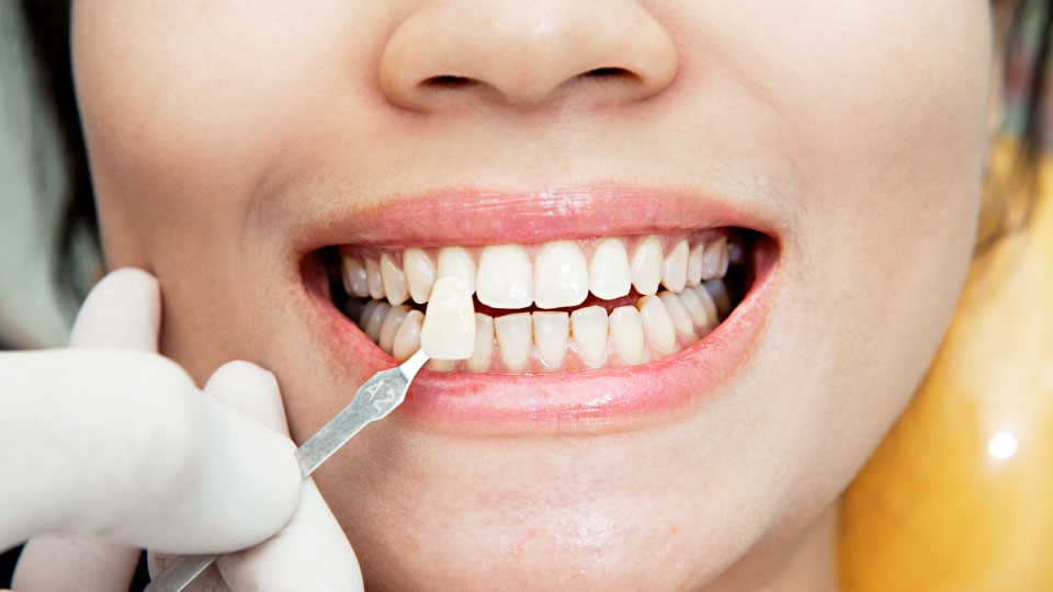 composite veneers 